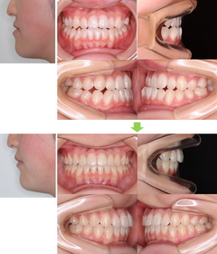 3.外科矯正～顎口腔機能診断指定医療機関としての保険適用治療
