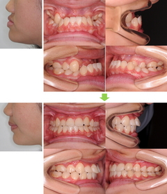 歯 列 矯正 保険 適用